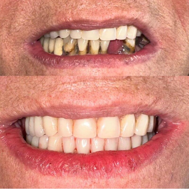 CASO CLINICO ALL ON FOUER ARCATA INFERIORE14