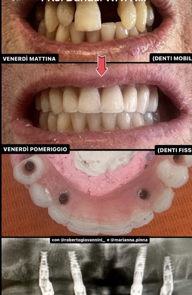 CASO CLINICO ALL ON FOUR ARCAT SUPERIORE 23