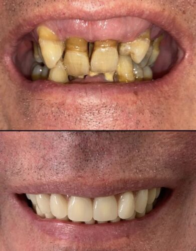 CASO CLINICO ALL ON FOUR ARCATA SUPERIORE 17