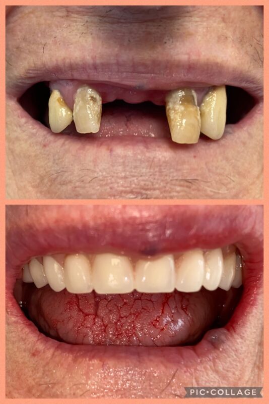 CASO CLINICO ALL ON FOUR ARCATA SUPERIORE 18