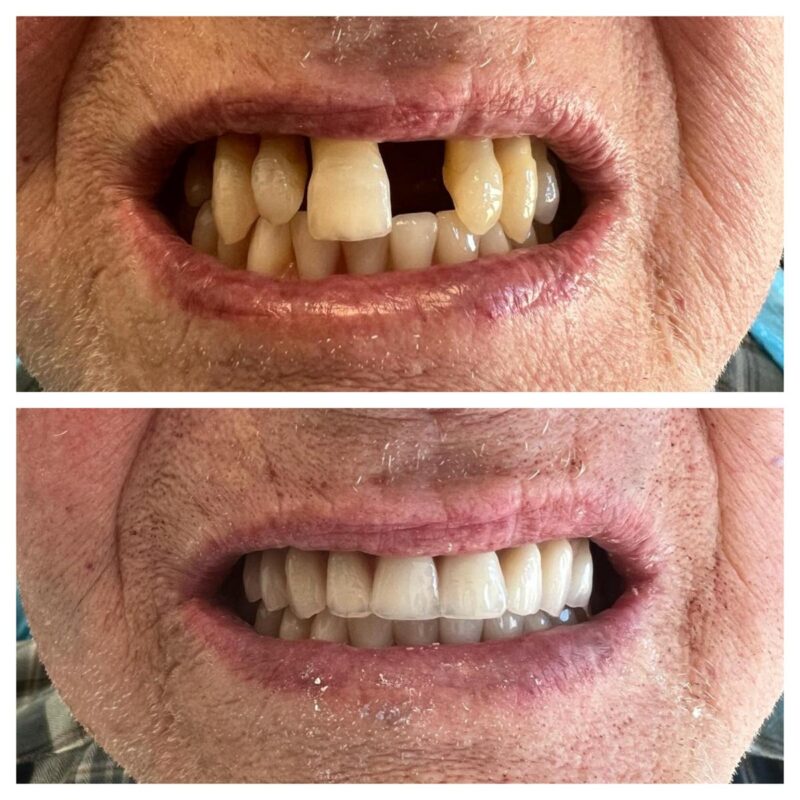 CASO CLINICO ALL ON FOUR ARCATA SUPERIORE 9