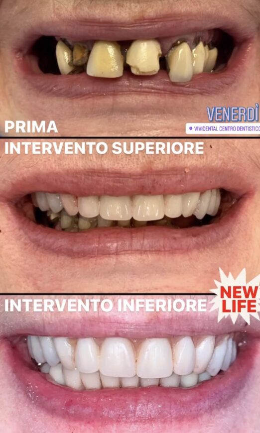 CASO CLINICO ALL ON FOUR ARCATA SUPERIORE E INFERIORE 13