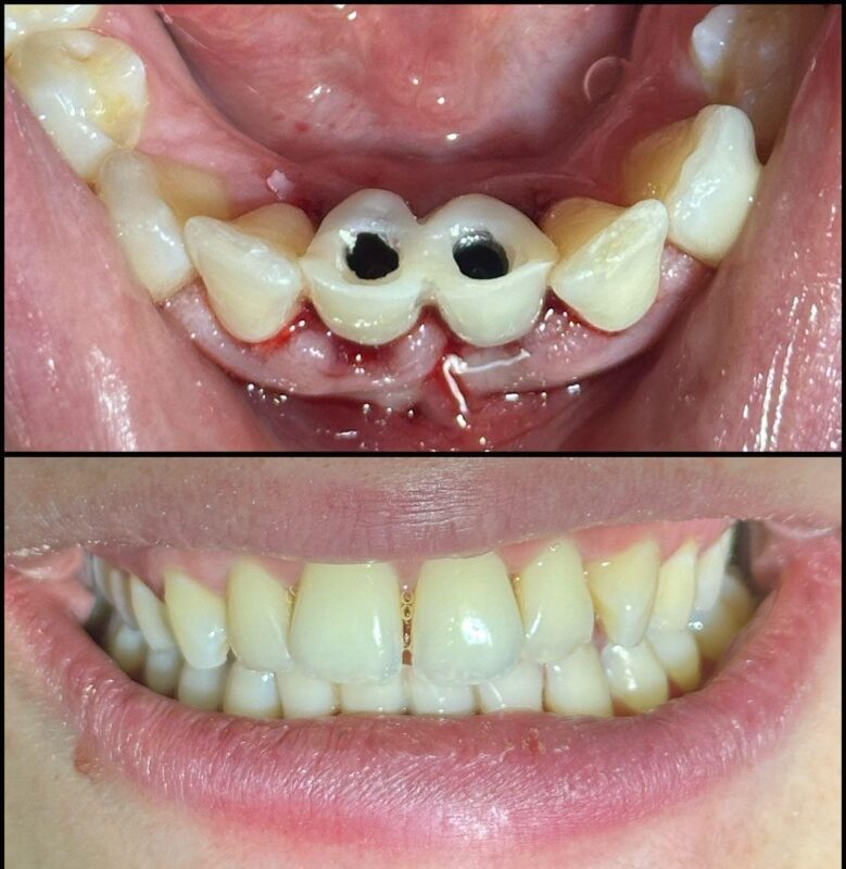 CASO CLINICO IMPLANTOLOGIA GUIDATA 2 ELEMENTI 1