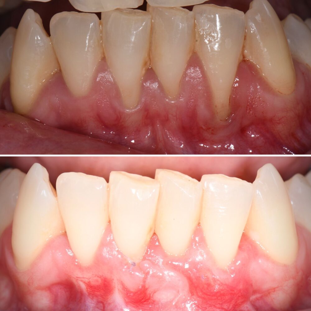 CASO CLINICO INTERVENTO RIGENERATIVA PARODONTALE12
