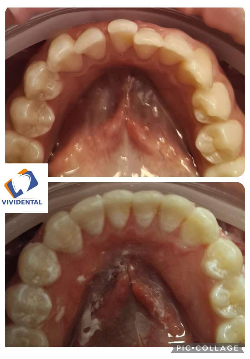 CASO CLINICO INVISALIGN ALLINEAMENTO ARCATA INFERIORE 4