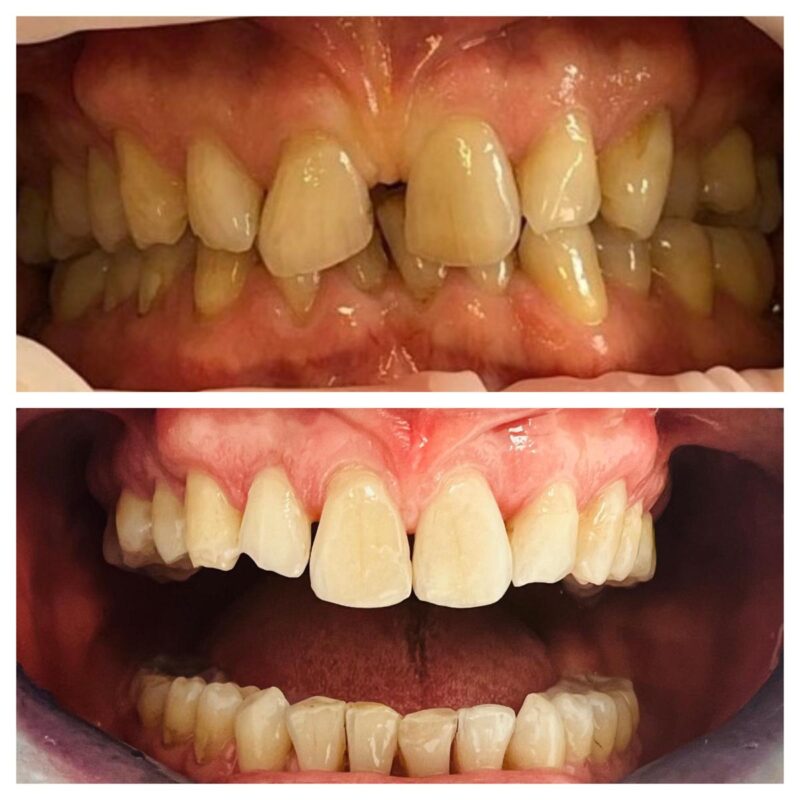 CASO CLINICO INVISALIGN DIASTEMA 8