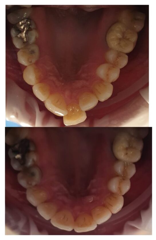 CASO CLINICO INVISALIGN ESPANSIONE ARCATA SUPERIORE E ALLINEAMENTO 15