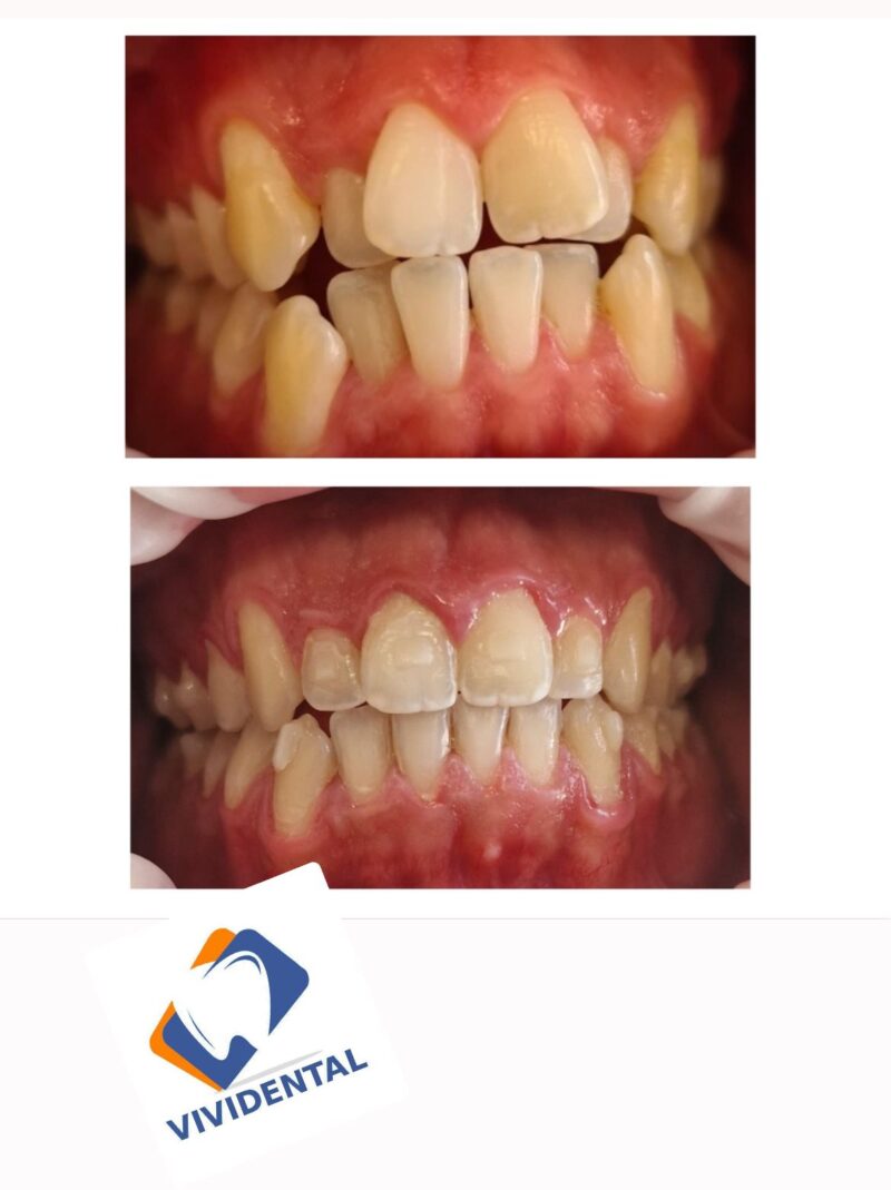 CASO CLINICO INVISALIGN GRAVE AFFOLLAMNETO ARCATA SUPERIORE E INFERIORE 6