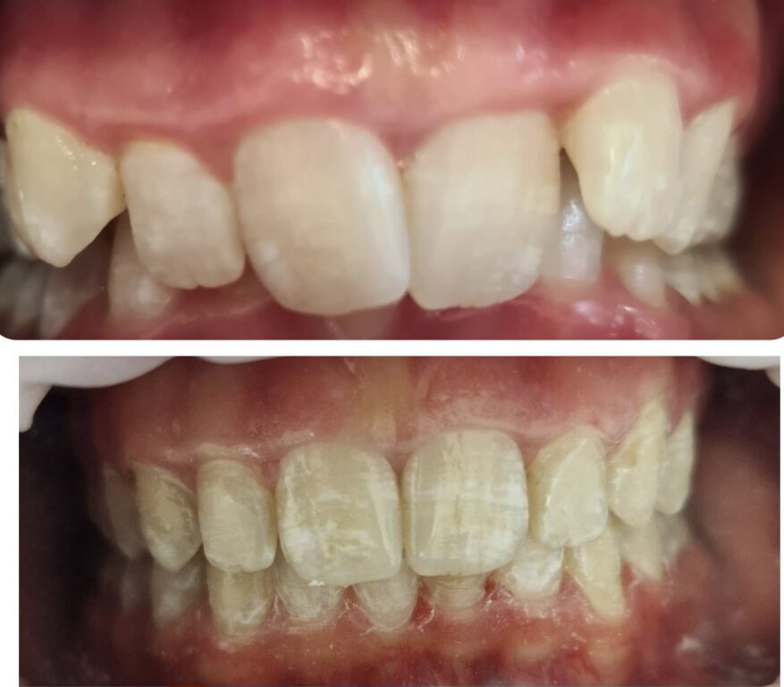 CASO CLINICO INVISALIGN MORSO PROFONDO SECONDA CLASSE 3