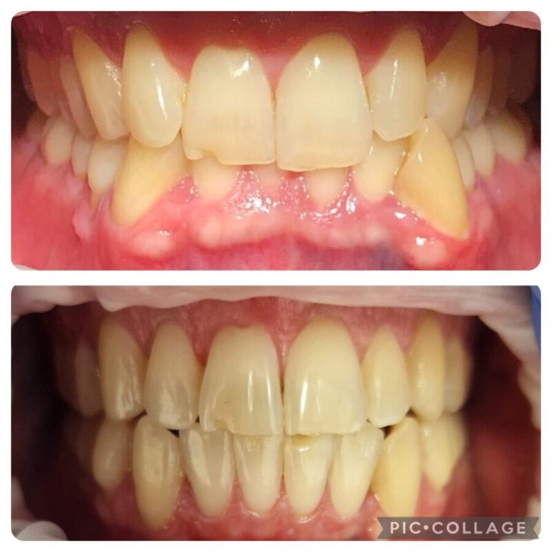 CASO CLINICO INVISALIGN RISOLUZIONE AFFOLLAMENTO E MORSO PROFONDO 5