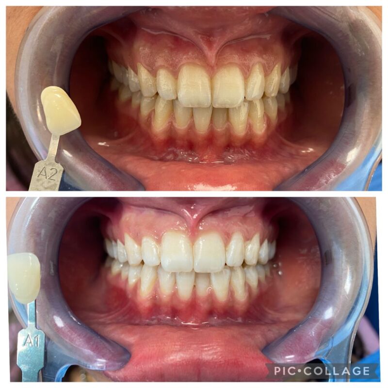 CASO CLINICO SBIANCAMENTO DENTALE21