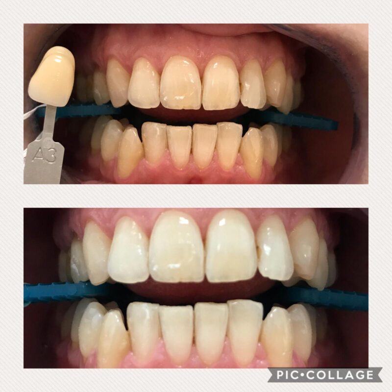 CASO CLINICO SBIANCAMENTO DENTALE22