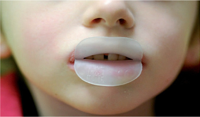 Froggy-Mouth-R-worn-for-15-minutes-a-day-in-front-of-the-TV-facilitates-automatic