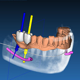foto-implantologia-guidata-1
