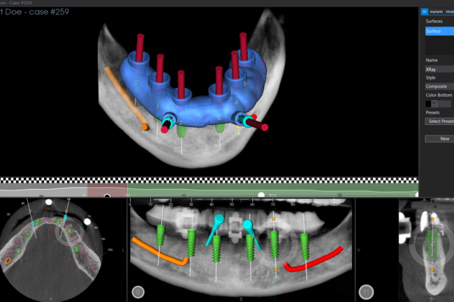 foto-implantologia-guidata-2