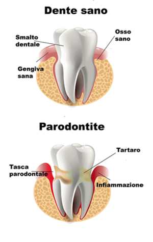 parodontologia-dente-sano-e-non-sano