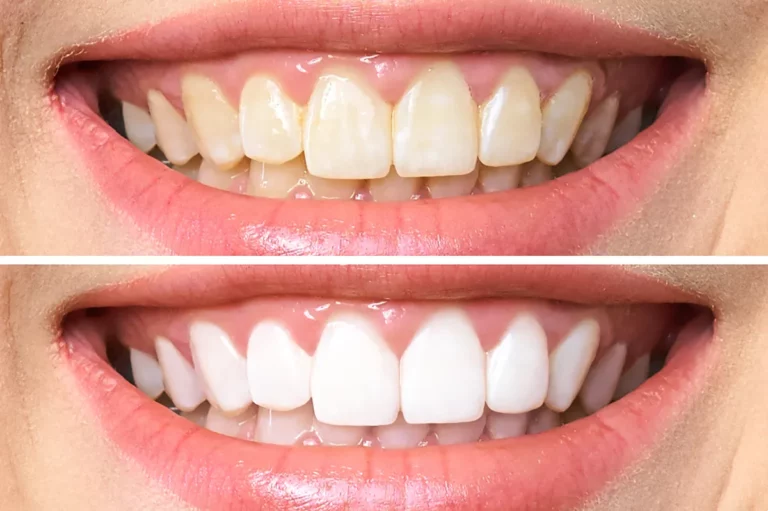 sbiancamento denti professionale