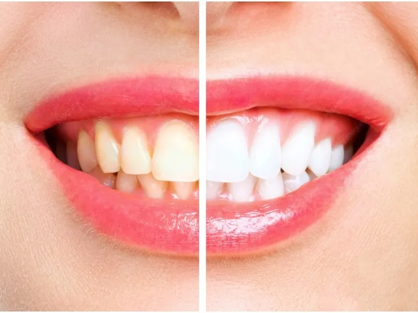 sbiancamento dentale