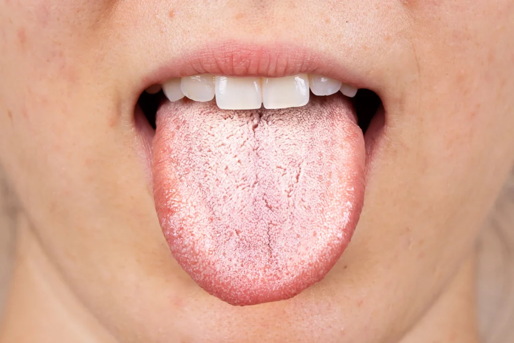lingua bianca dentista