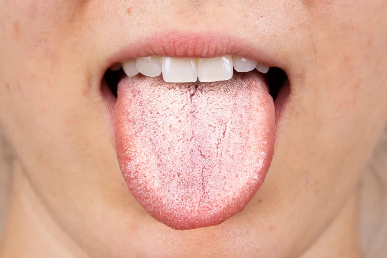 lingua bianca dentista