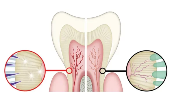 denti sensibili al caldo e freddo