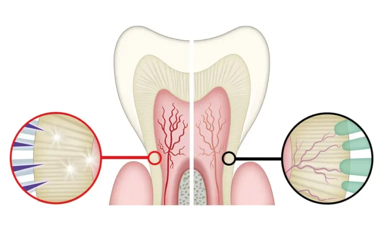 denti sensibili al caldo e freddo