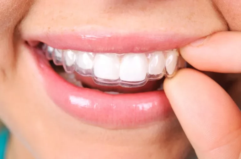 allineatori invisibili denti invisaling